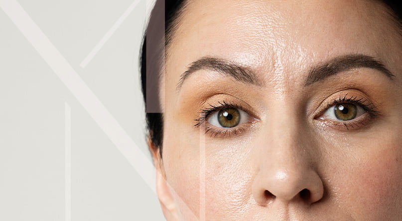marta-nagai-imagem-interna-blefaroplastia